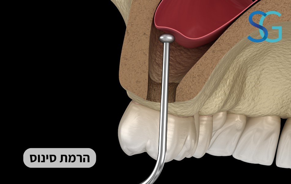 הרמת סינוס פתוחה