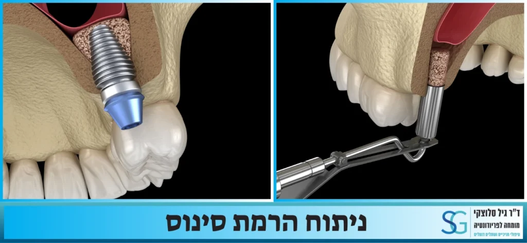 הרמת סינוס